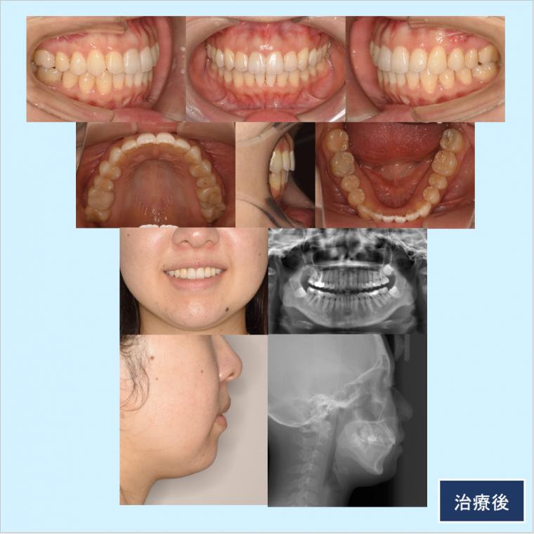 No.26 軽度の叢生をマウスピース矯正（インビザライン）で短期間で改善した症例