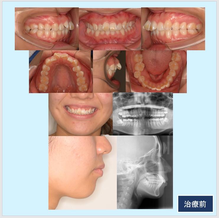 No.28 マウスピース矯正＆小臼歯抜歯症例