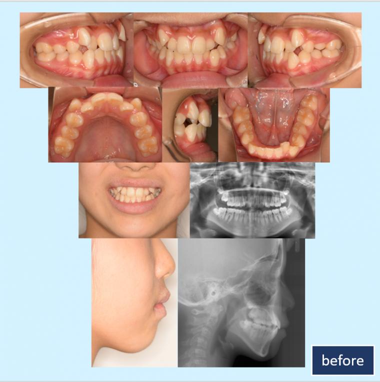 No.23 第1期治療後に小臼歯抜歯をして短期間で叢生を改善した症例