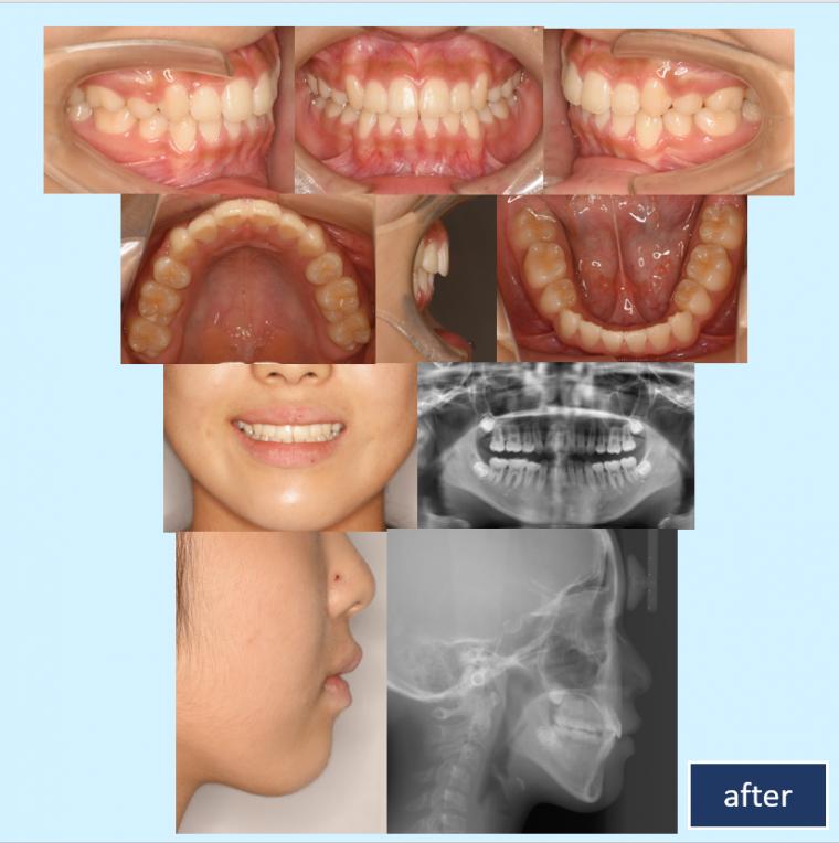No.23 第1期治療後に小臼歯抜歯をして短期間で叢生を改善した症例