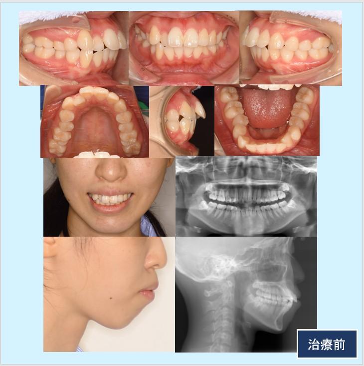 No.50 フルリンガルで口ゴボを改善した症例