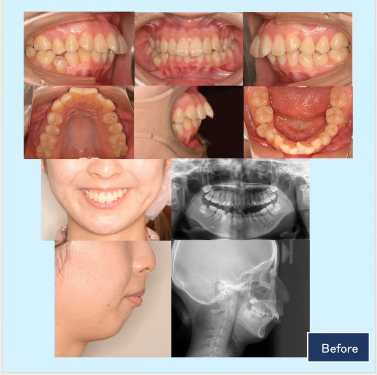 No.52 口ゴボと下顎後退症をハーフリンガルで改善した症例