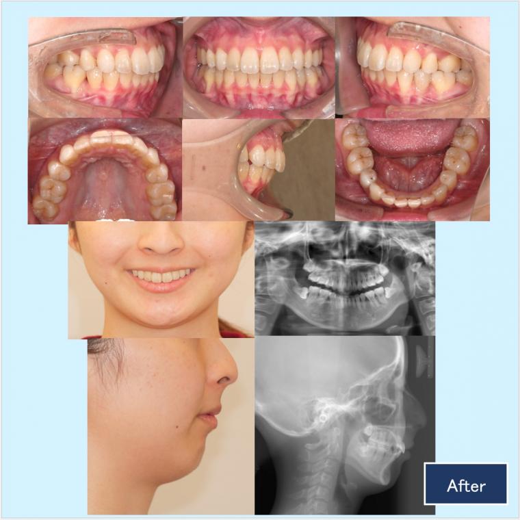 No.52 口ゴボと下顎後退症をハーフリンガルで改善した症例