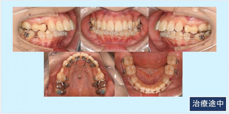 No.52 口ゴボと下顎後退症をハーフリンガルで改善した症例