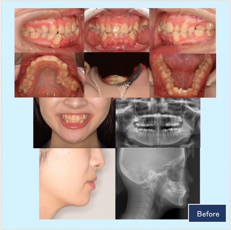 No.53 ハーフリンガルで歯列不整と狭窄歯列を改善した症例