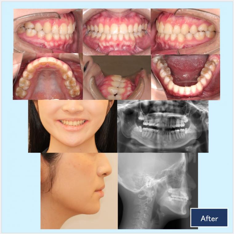No.53 ハーフリンガルで歯列不整と狭窄歯列を改善した症例