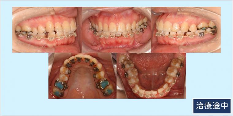 No.53 ハーフリンガルで歯列不整と狭窄歯列を改善した症例