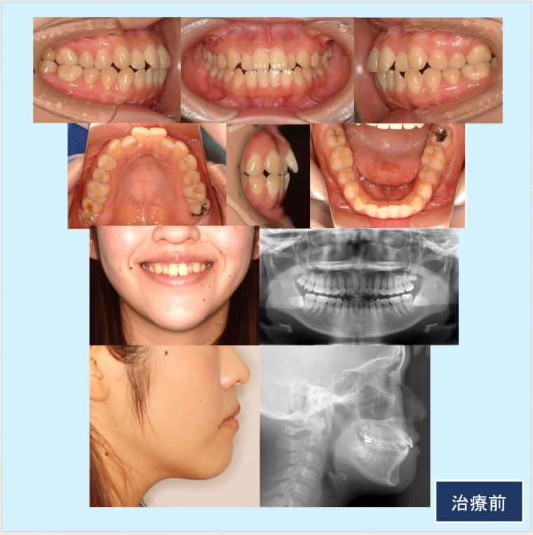 No.56 ハーフリンガルとマウスピース治療のコンビネーションで治した上下顎前突症例