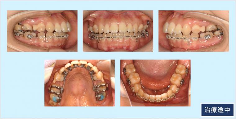 No.56 ハーフリンガルとマウスピース治療のコンビネーションで治した上下顎前突症例