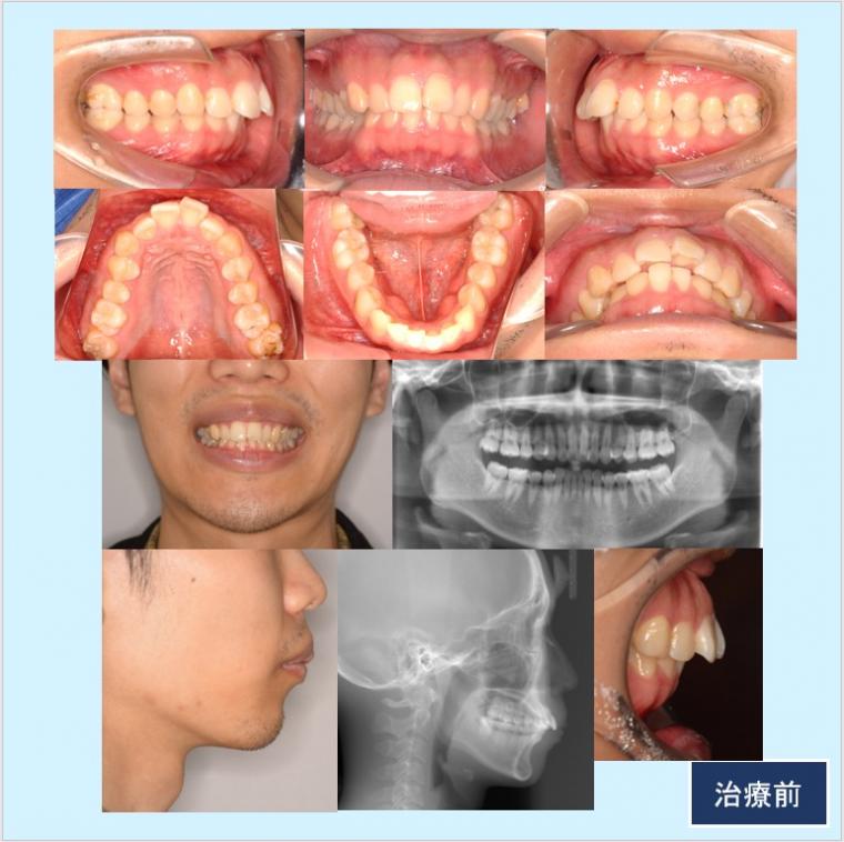 No.54 フルリンガル(上下裏側矯正)口ゴボ改善症例