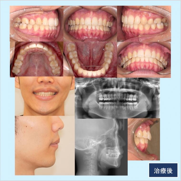 No.54 フルリンガル(上下裏側矯正)口ゴボ改善症例