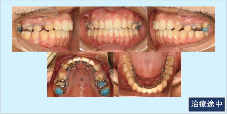 No.54 フルリンガル(上下裏側矯正)口ゴボ改善症例
