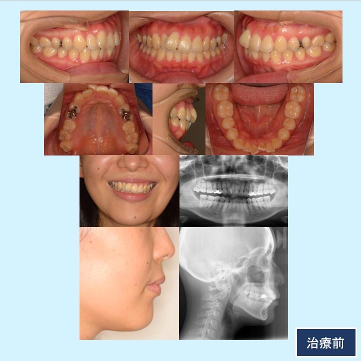 No.4 非抜歯のブラケット＆マウスピースによるコラボレーション症例（補綴物の歯冠幅径を減少して歯を削らなかった）