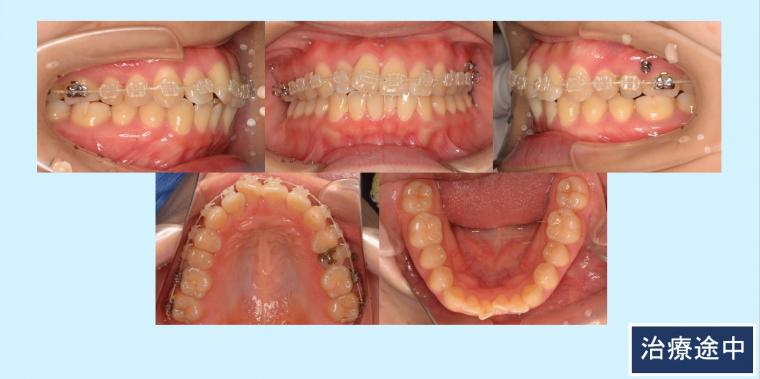 No.4 非抜歯のブラケット＆マウスピースによるコラボレーション症例（補綴物の幅を減少することで歯を削らない対応をした症例）