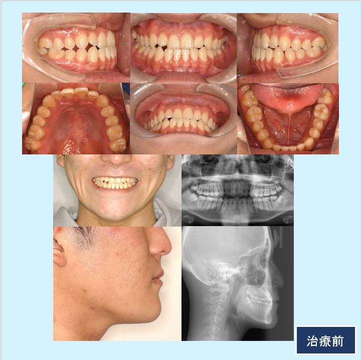 No.55 外科矯正をせずに矯正治療単独で切端咬合を改善した下顎前突症例