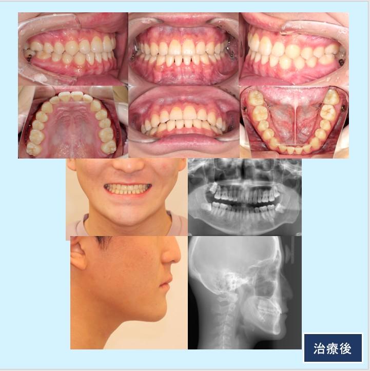 No.55 外科矯正をせずに矯正治療単独で切端咬合を改善した下顎前突症例