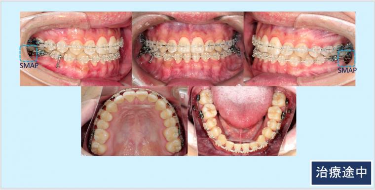 No.55 外科矯正をせずに矯正治療単独で切端咬合を改善した下顎前突症例
