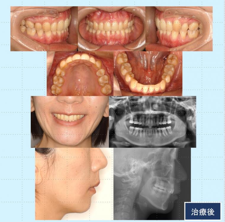 No.41 ハーフリンガルで口元の突出感と叢生を改善した症例