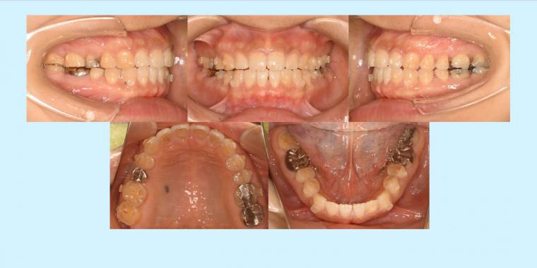 No.3 舌突出によるすきっ歯を治したマウスピース症例