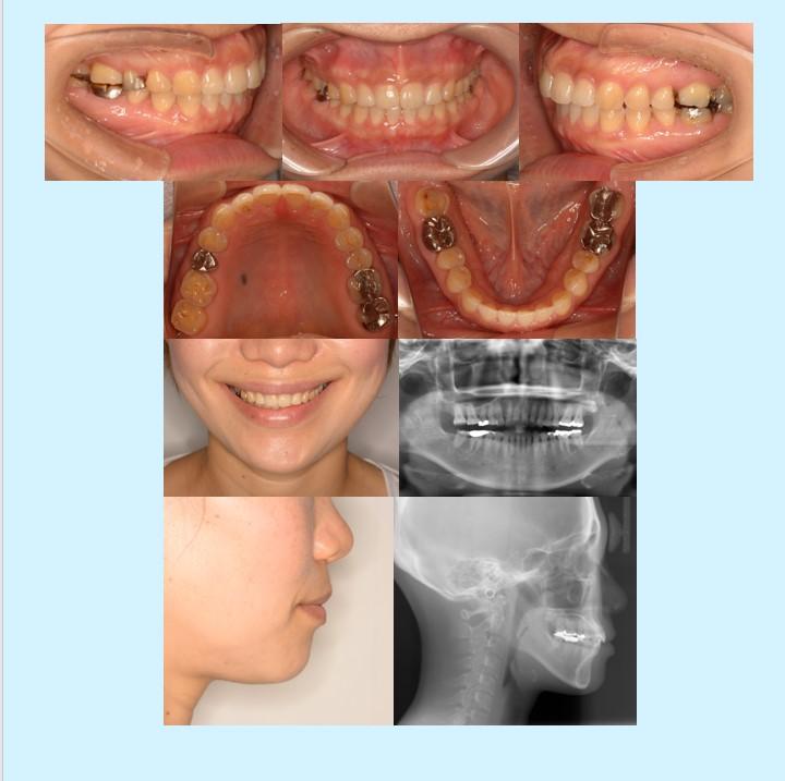 No.3 舌突出によるすきっ歯を治したマウスピース症例