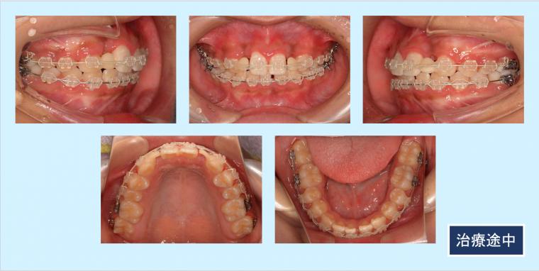 No.25 矮小歯の前歯を抜歯して、側貌と歯列不整を審美的に改善した症例