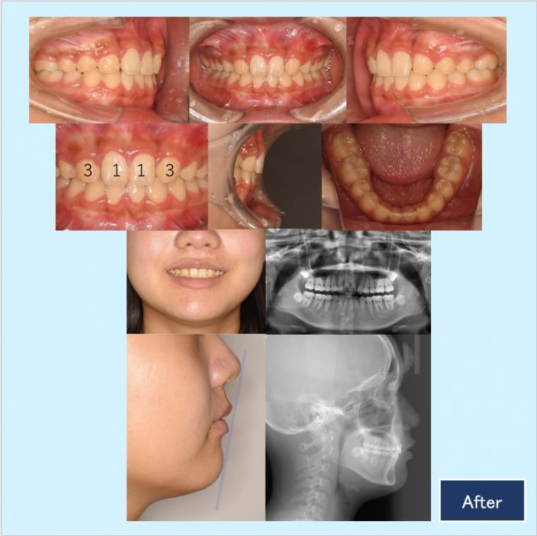 No.25 矮小歯の前歯を抜歯して、側貌と歯列不整を審美的に改善した症例