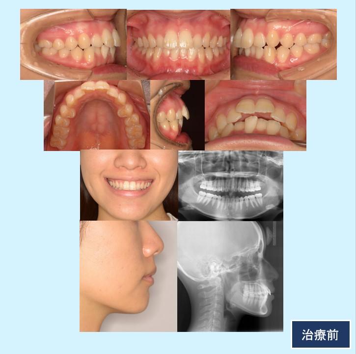 No.11前歯のガタガタを短期間のマウスピース矯正で治した症例