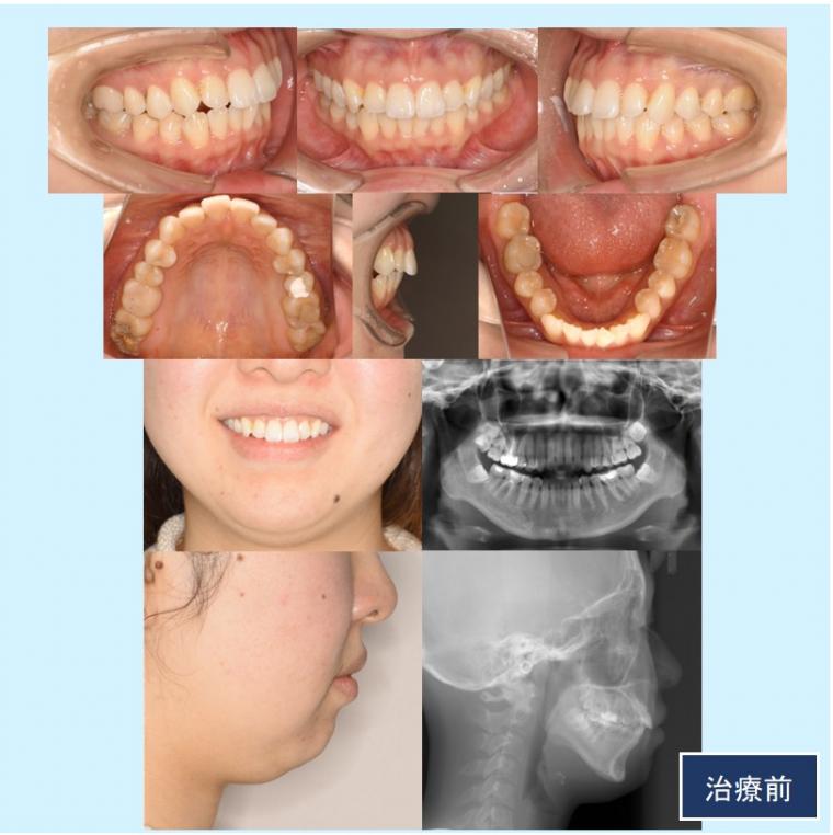 No.57 前歯突出感をマウスピース矯正（インビザライン）で短期間で改善した症例