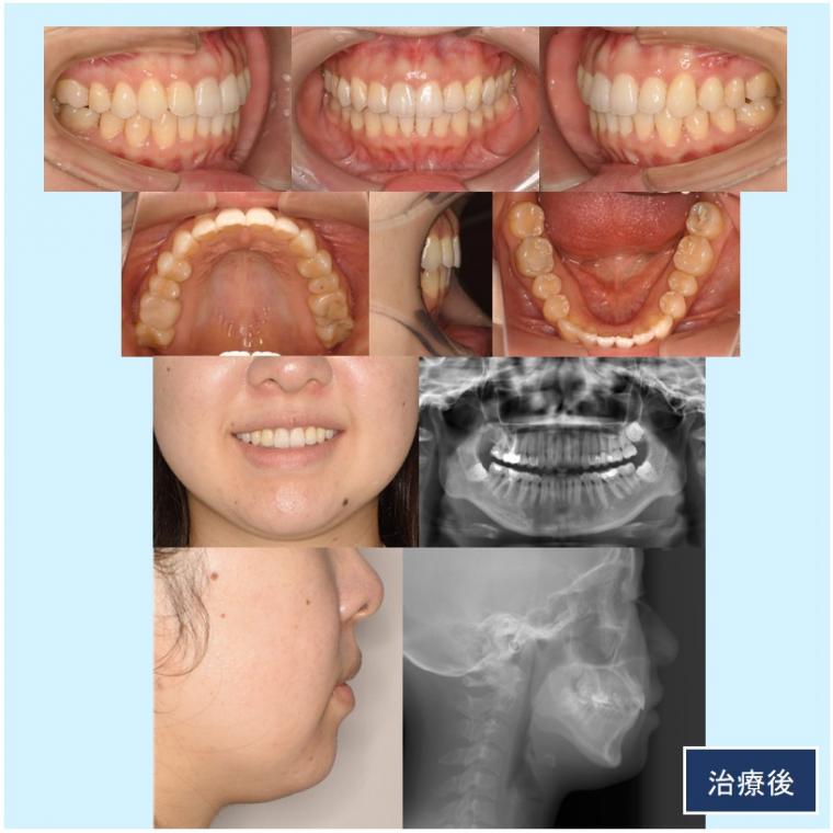 No.57 前歯突出感をマウスピース矯正（インビザライン）で短期間で改善した症例