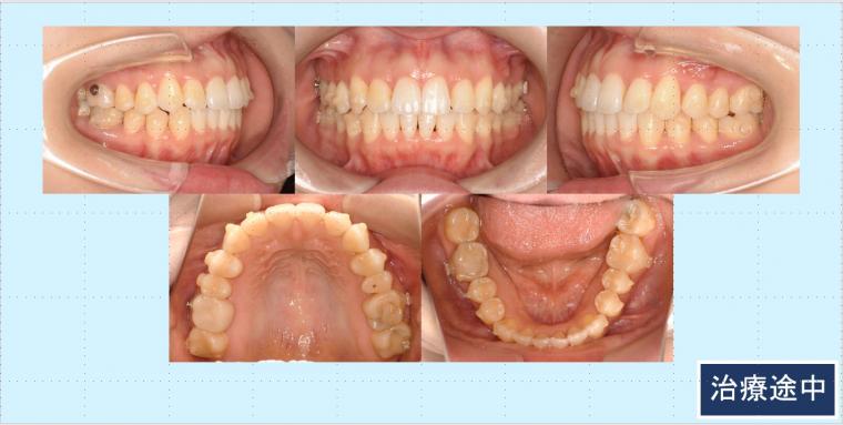 No.57 前歯突出感をマウスピース矯正（インビザライン）で短期間で改善した症例