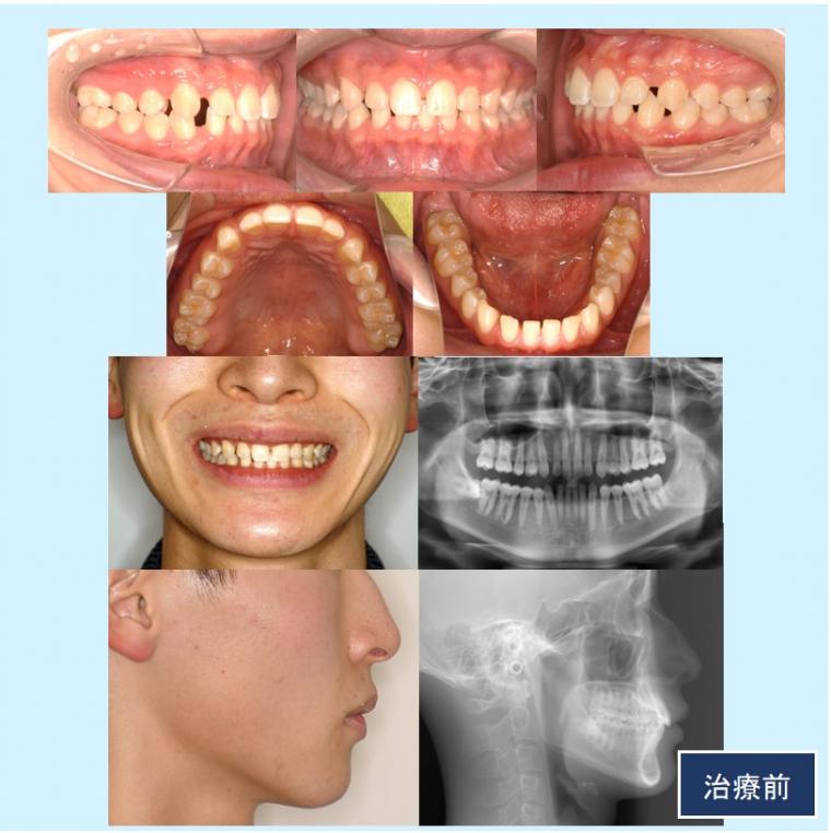 No.58 マウスピース矯正治療(インビザライン)ですきっ歯を改善した症例