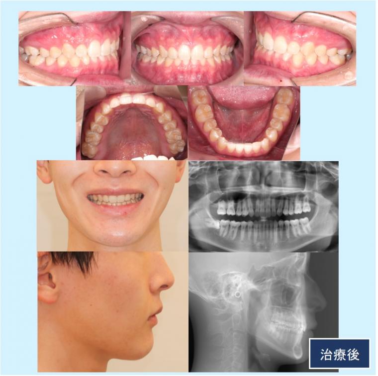 No.58 マウスピース矯正治療(インビザライン)ですきっ歯を改善した症例