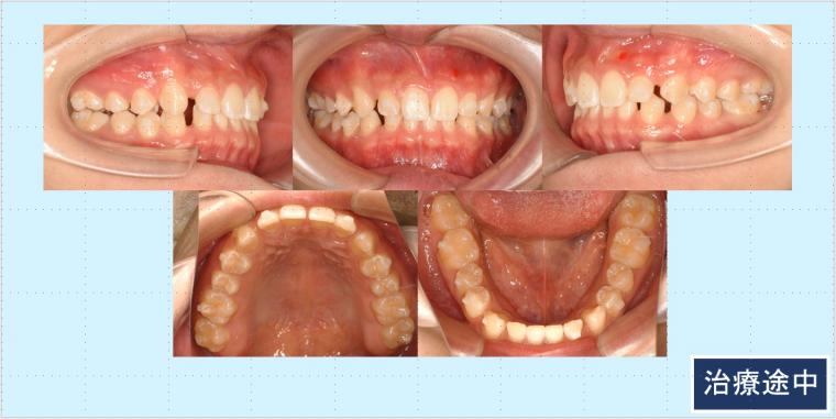 No.58 マウスピース矯正治療(インビザライン)ですきっ歯を改善した症例