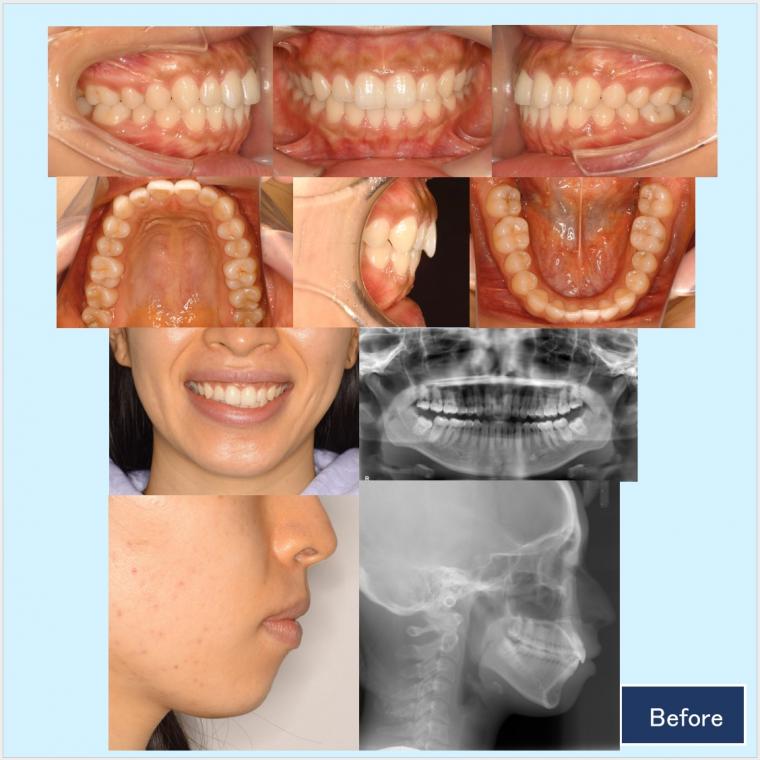 No.59 ハーフリンガルで軽度なガミースマイルと口ゴボを改善した症例　