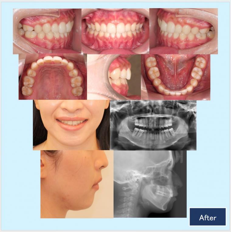 No.59 ハーフリンガルで軽度なガミースマイルと口ゴボを改善した症例　