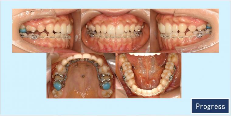 No.59 ハーフリンガルで軽度なガミースマイルと口ゴボを改善した症例　