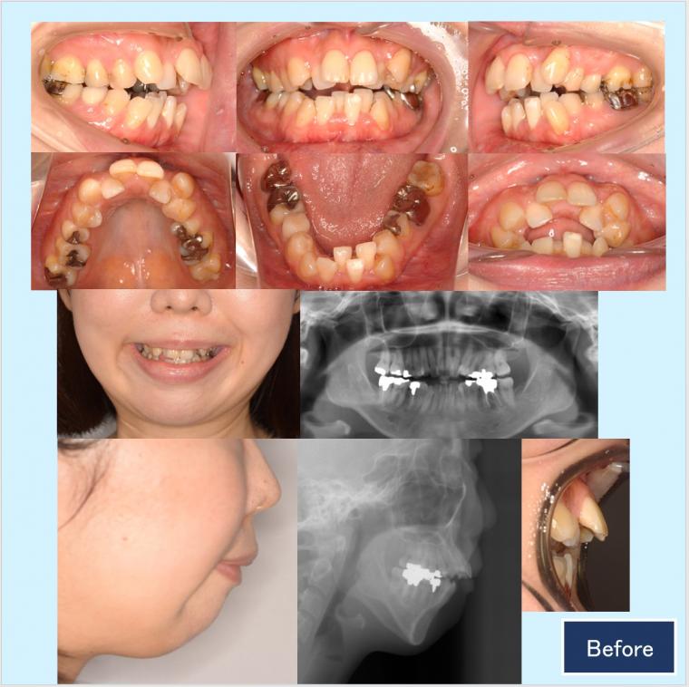 No.60 口ゴボと下顎後退症を口蓋型歯科矯正用アンカースクリュー(i-station)で改善した症例
