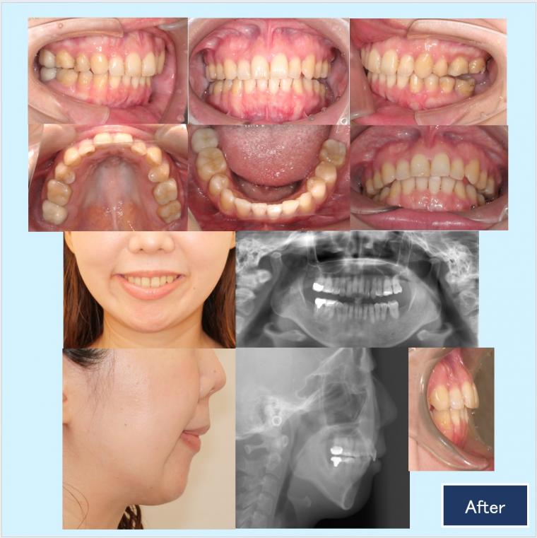 No.60 口ゴボと下顎後退症を口蓋型歯科矯正用アンカースクリュー(i-station)で改善した症例