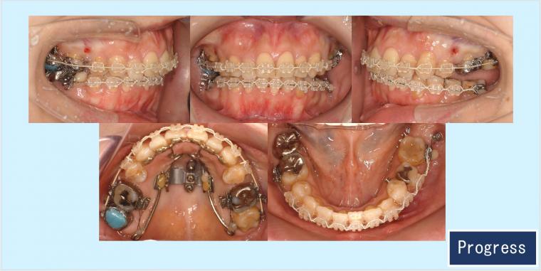 No.60 口ゴボと下顎後退症を口蓋型歯科矯正用アンカースクリュー(i-station)で改善した症例