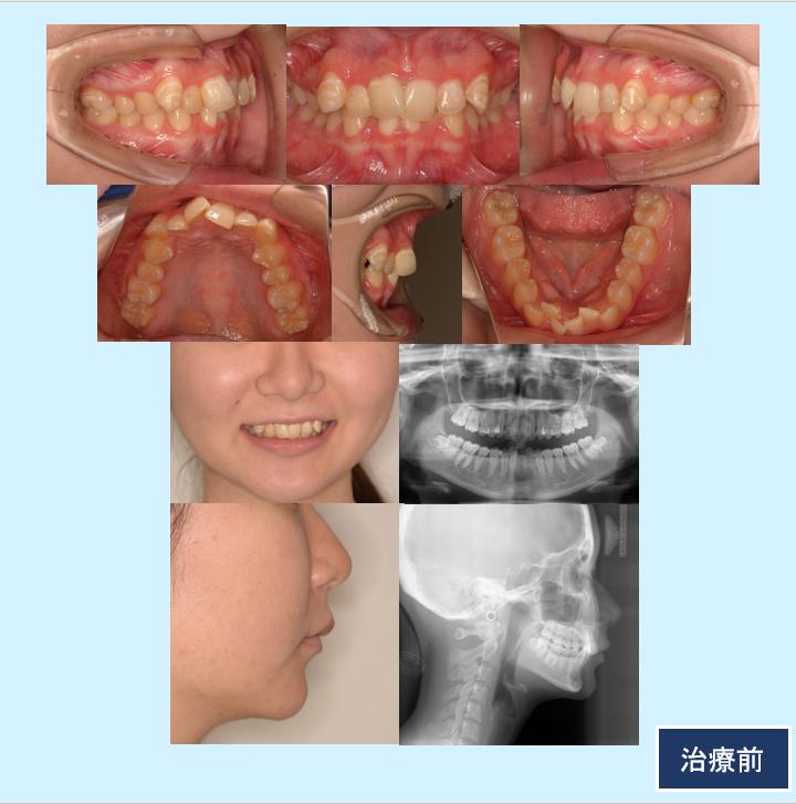 No.12 小臼歯抜歯と歯科用アンカースクリューで叢生と口元のラインを治した症例