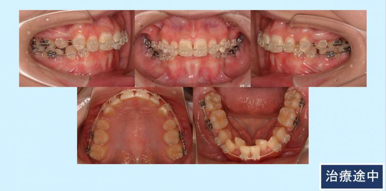 No.12 小臼歯抜歯と歯科用アンカースクリューで叢生と口元のラインを治した症例