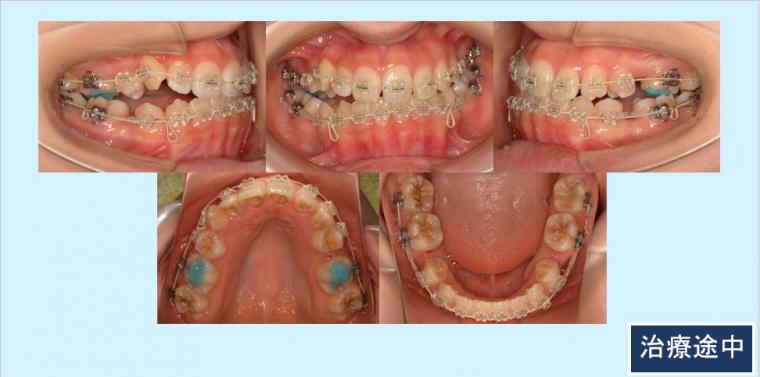 No.13 唇側プラスチックブラケットで八重歯と正中のズレを治した症例