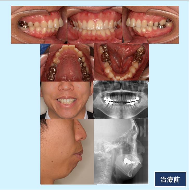 No.14 歯科用アンカースクリューとオーダーメイド製マルチブラケット装置（インシグニア）で出っ歯を治した症例