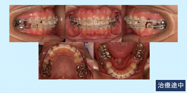 No.14 歯科用アンカースクリューとオーダーメイド製マルチブラケット装置（インシグニア）で出っ歯を治した症例