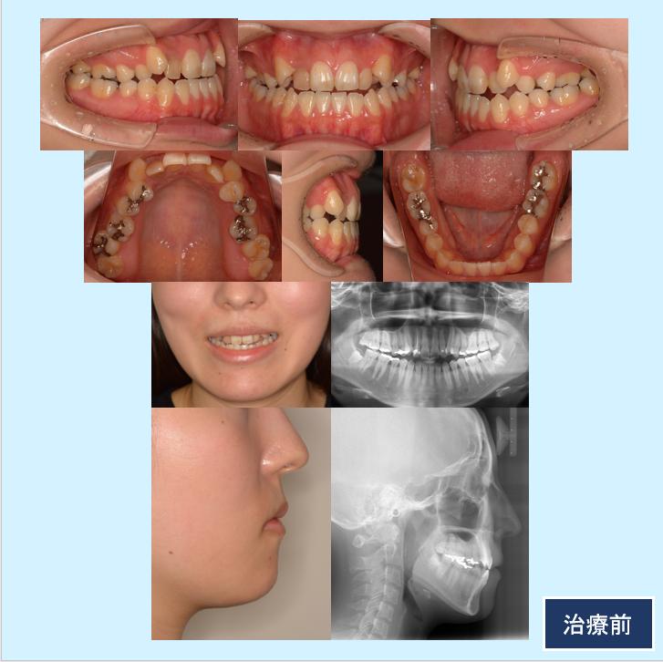 No.16 舌側矯正装置（アリアス）で八重歯と切端咬合を治した症例
