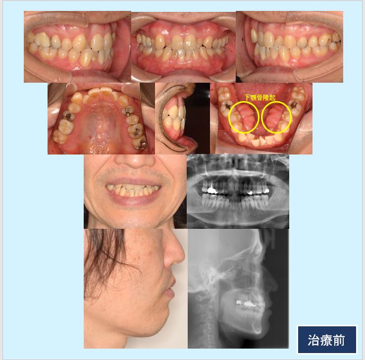 No.29 下顎骨隆起を伴う歯列不整をマウスピース型矯正治療と骨隆起切除術で治した症例