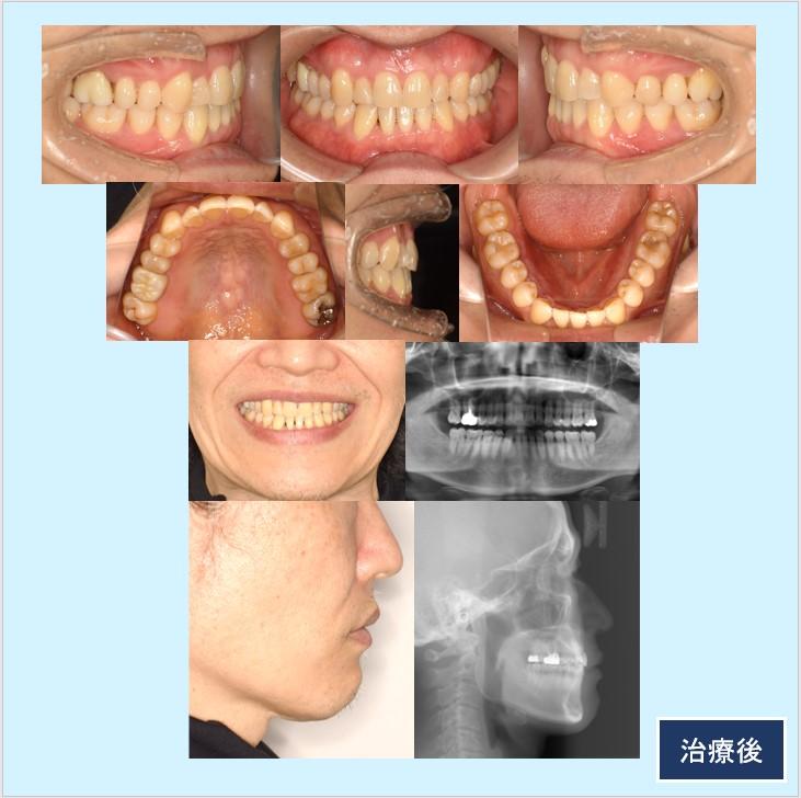 No.29 下顎骨隆起を伴う歯列不整をマウスピース型矯正治療と骨隆起切除術で治した症例