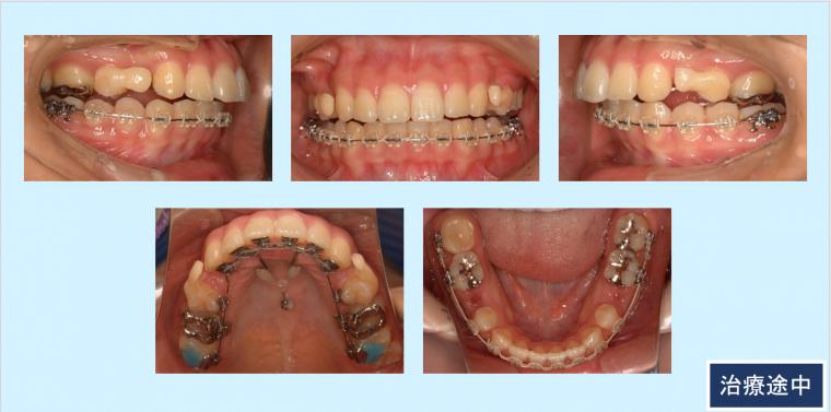 No.18 ハーフリンガルと歯科用アンカースクリューで口元の突出感を治した症例