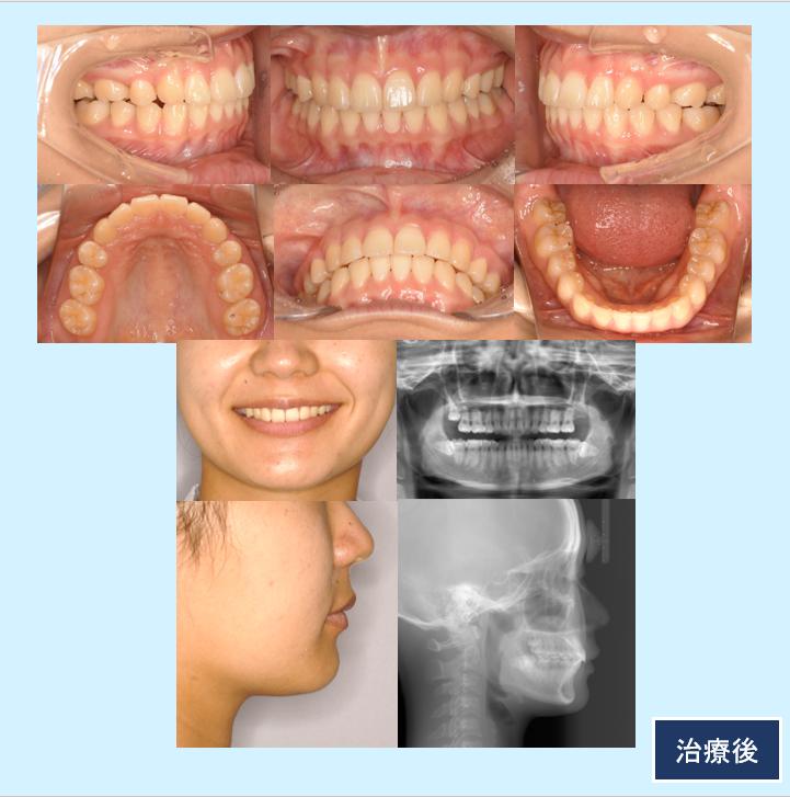 No.18 ハーフリンガルと歯科用アンカースクリューで口元の突出感を治した症例