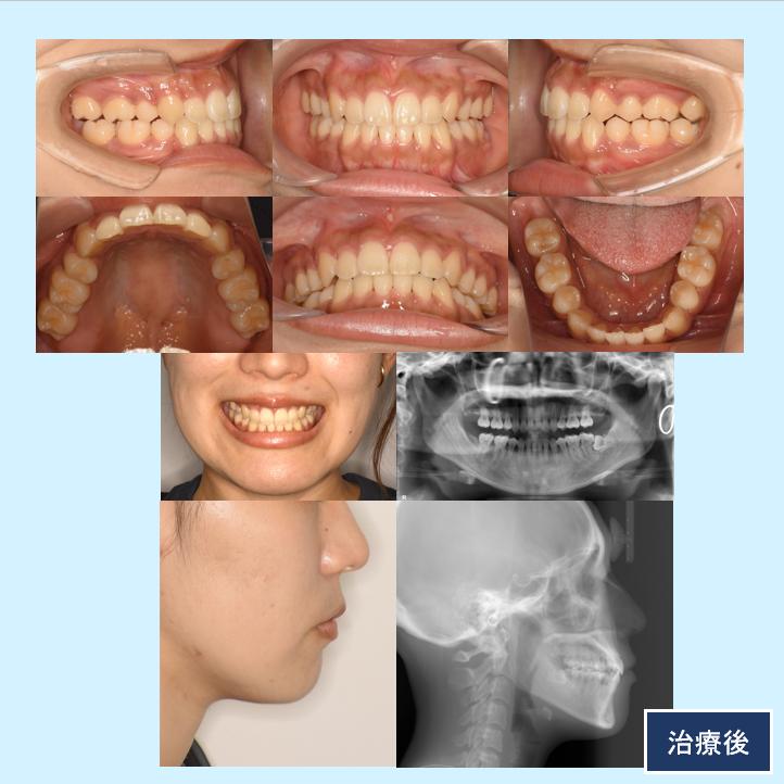 No.20  外科矯正をせずに下あごの曲がりを出来る限り改善して、八重歯と口元突出感を治した症例